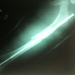 IGSS osteogenesis imperfecta hospital general de enfermedades guatemala-1