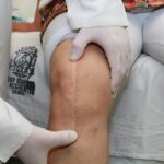 operacion de rodilla artroplastia hospital de accidentes igss 2019-12
