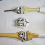 operacion de rodilla artroplastia hospital de accidentes igss 2019-14