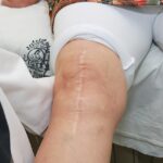 operacion de rodilla artroplastia hospital de accidentes igss 2019-6
