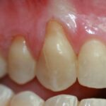 retraccion gingival igss-1
