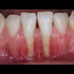retraccion gingival igss-2