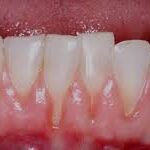 retraccion gingival igss-3