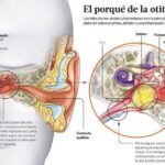 Prensa Libre Salud Otitis Media IGSS 2020-03