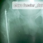 EL IGSS brinda atención médica a niños con padecimientos de “huesos de cristal” 2-2