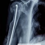 EL IGSS brinda atención médica a niños con padecimientos de “huesos de cristal” 2-3