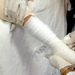 EL IGSS brinda atención médica a niños con padecimientos de “huesos de cristal” 2-5