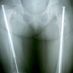 EL IGSS brinda atención médica a niños con padecimientos de “huesos de cristal” 2-6