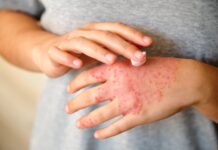 IGSS reporta nueve casos de sarampión en sus unidades