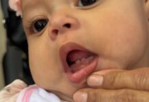 ¿Son los dientes o una enfermedad? Claves para identificar el brote dental en los niños