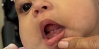 ¿Son los dientes o una enfermedad? Claves para identificar el brote dental en los niños